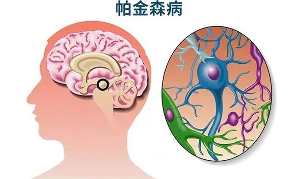 正式批准：12月开始静脉和脊髓腔注射干细胞治疗帕金森病