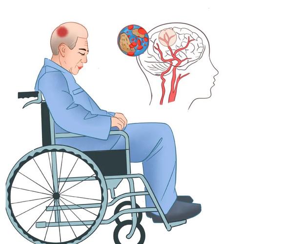 47项临床试验数据揭示：干细胞为中风康复提供了一条很有前景的途径