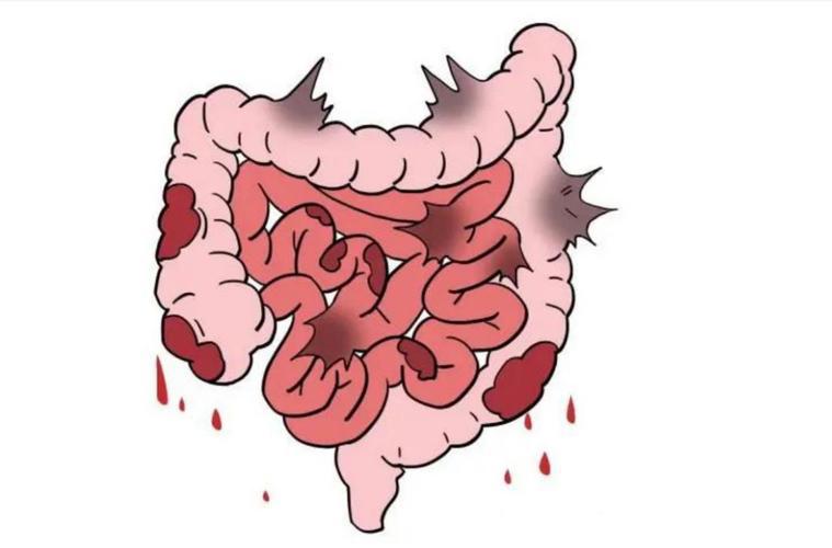 干细胞治疗炎症性肠病的研究进展