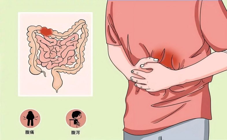 间充质干细胞产品及其外泌体在炎症性肠病治疗中的研究进展